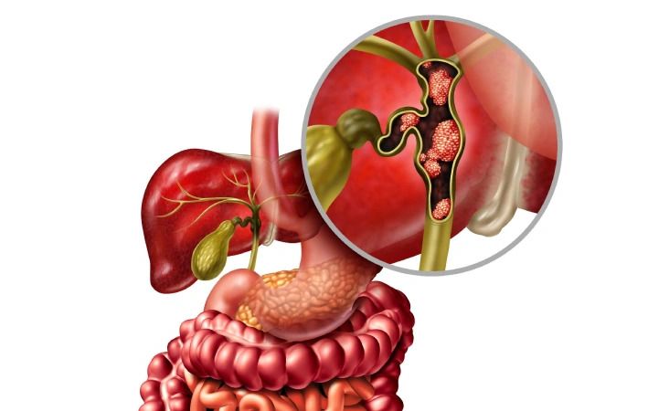 GI Oncology