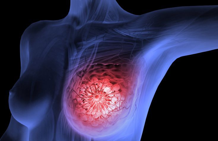 Chemoport Placement