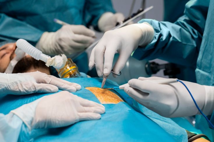 HIPEC and PIPAC Surgery